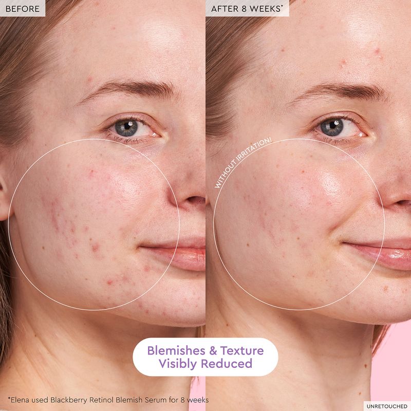 Suero-Blackberry-Retinol-Blemish-Serum