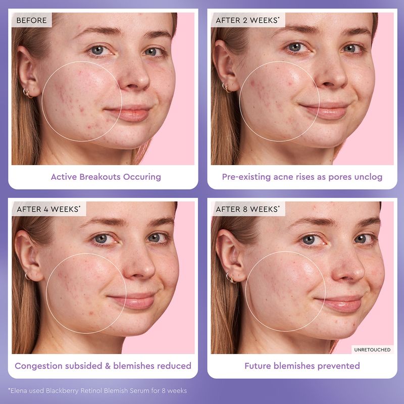 Suero-Blackberry-Retinol-Blemish-Serum